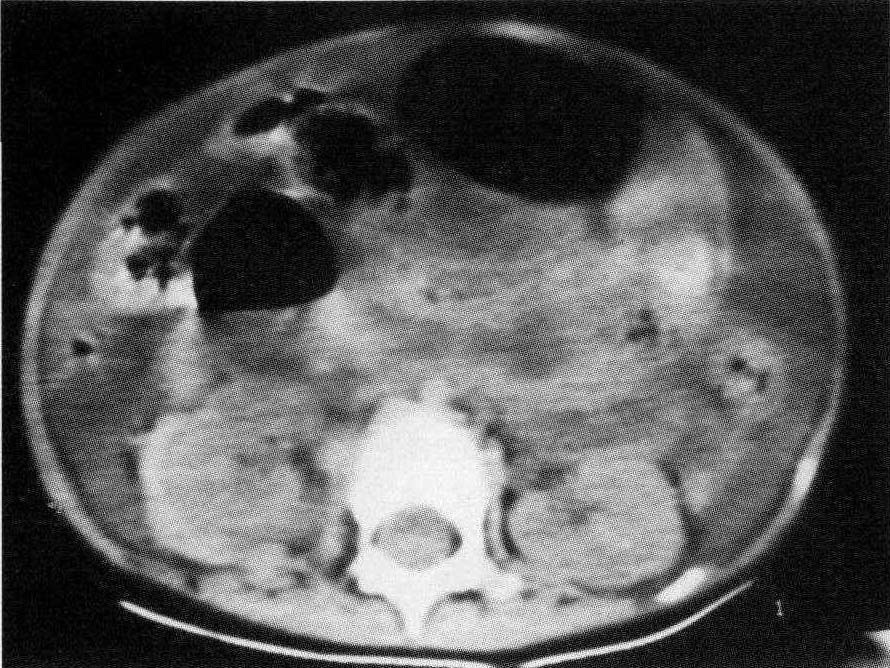 五、腸和腸系膜損傷